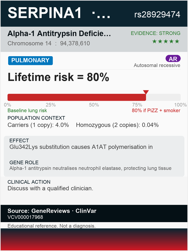 SERPINA1 alpha-1 antitrypsin deficiency (rs28929474)